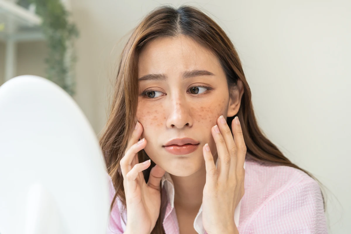 Woman examining facial sun spots and pigmentation before BBL HEROic treatment for clearer, more even skin tone